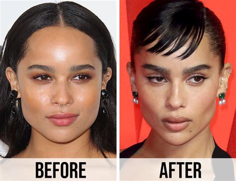 zoe kravitz surgery